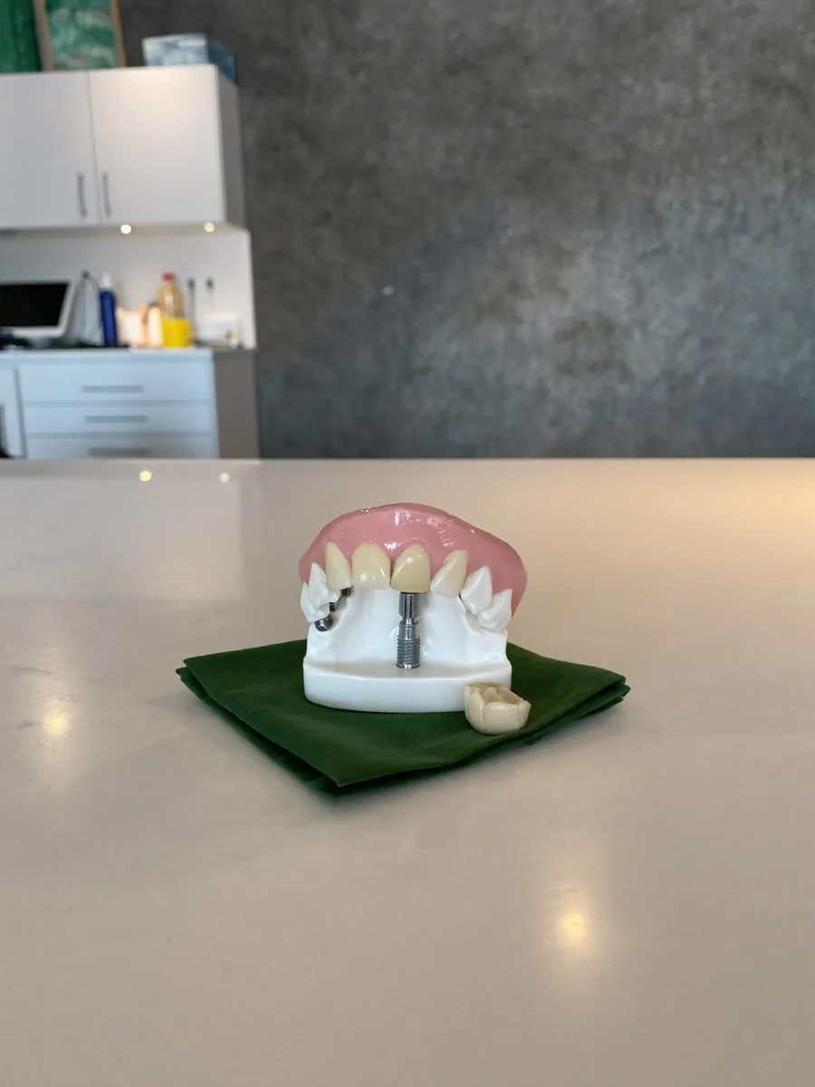 Um modelo de arcada com um implante de titânio no espaço do dente que falta e a coroa ao lado.